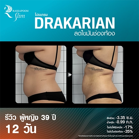 DRAKARIAN breaks down subcutaneous fat.