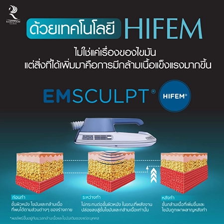 Emsculpt สร้างกล้ามเนื้อ ลดไขมัน