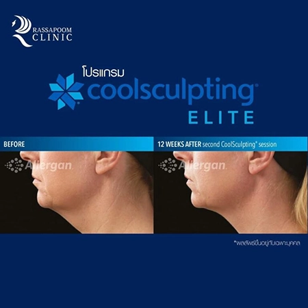 CoolSculpting Elite สลายไขมันด้วยความเย็น