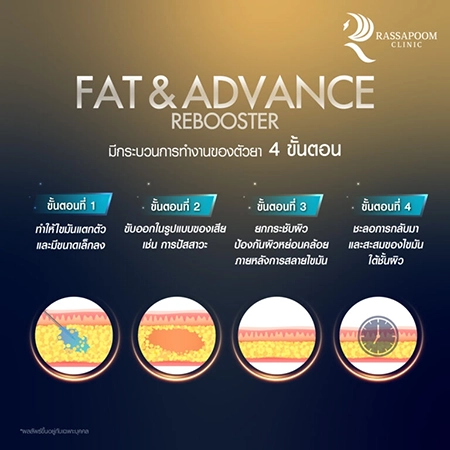 Fat injection to dissolve fat Fat injection to dissolve fat