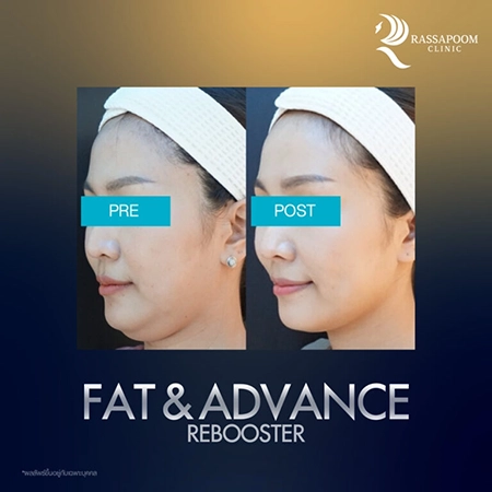 Fat injection to dissolve fat Fat injection to dissolve fat