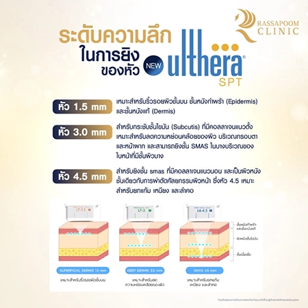 Ulthera ยกกระชับผิว