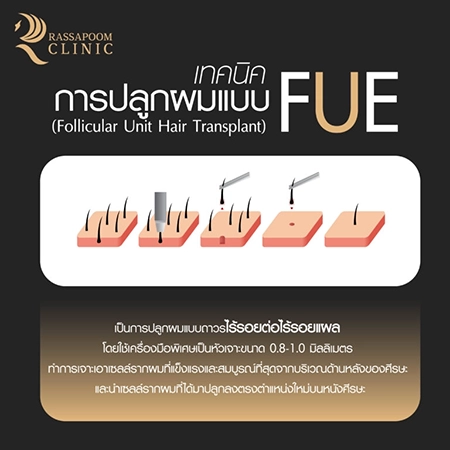 ปลูกผมถาวร FUE