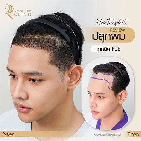 ปลูกผมถาวร FUE