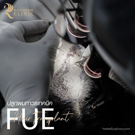 ปลูกผมถาวร FUE