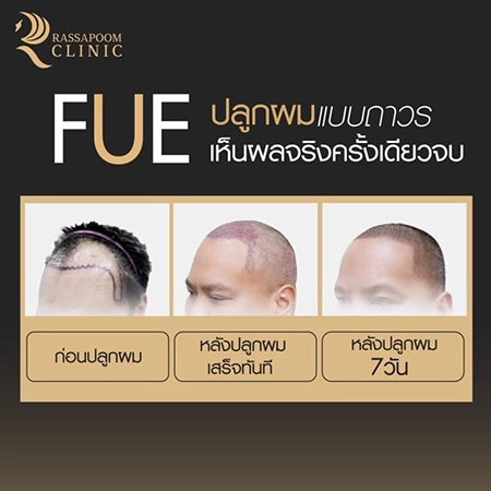 ปลูกผมถาวร FUE