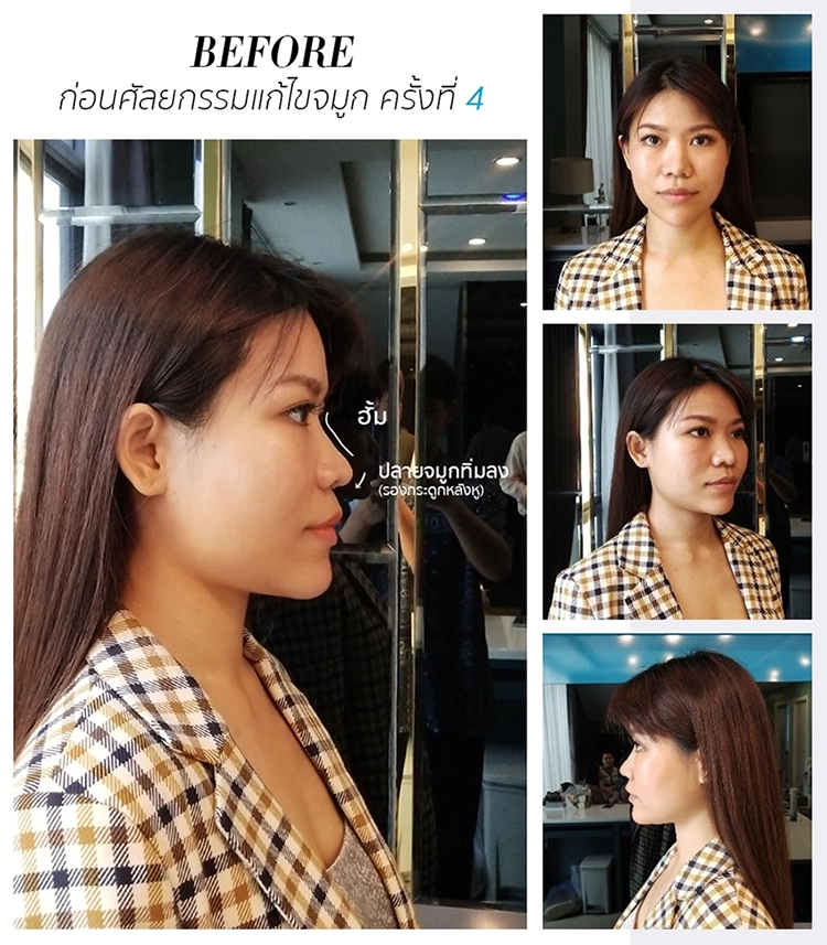 รีวิวศัลยกรรมแก้ไขจมูก (คุณนุก สาวิตรี ราชภักดี)