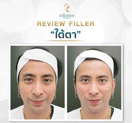 Under eye filler injections