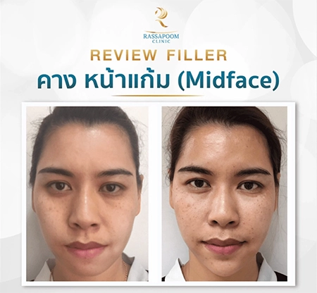 Orange cheek filler injection (Midface)