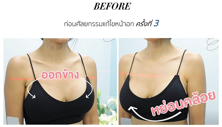 รีวิวศัลยกรรมแก้ไขหน้าอก (คุณปอ สิตานันท์ จันสักรา)