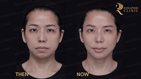 Triangular Face Lift