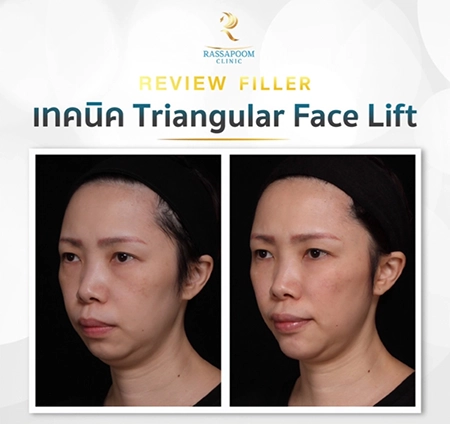 Triangular Face Lift