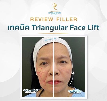 Triangular Face Lift