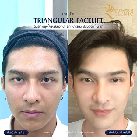 ฉีดฟิลเลอร์ (Triangular Face Lift)