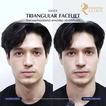 ฉีดฟิลเลอร์ (Triangular Face Lift)