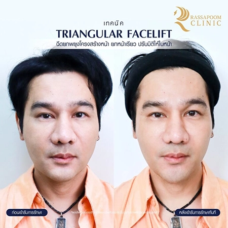 ฉีดฟิลเลอร์ (Triangular Face Lift)