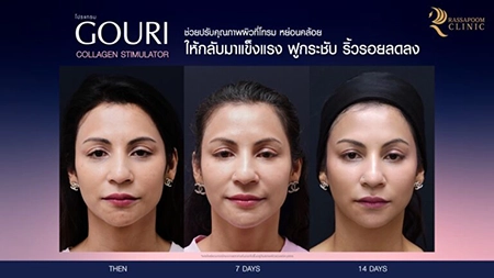 Gouri injections stimulate collagen