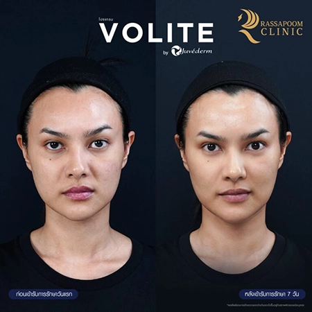 ฉีดฟิลเลอร์ (New Juvederm Volite)