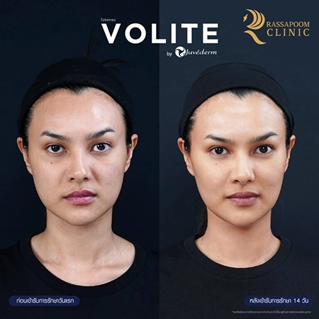 ฉีดฟิลเลอร์ (New Juvederm Volite)