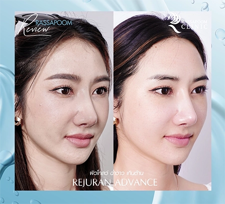 Rejuran Advance คุณยีนส์ เกวลิน ศรีวรรณา