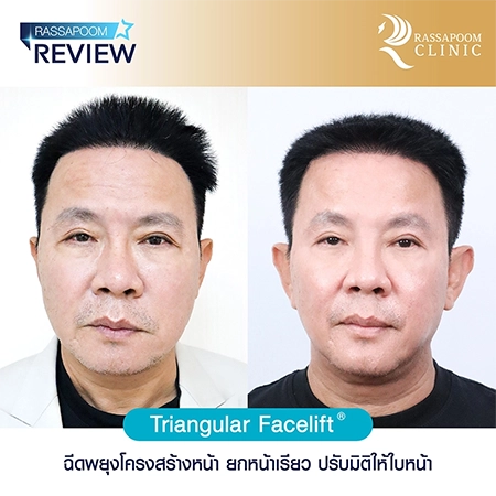 Triangular Face Lift ลุงรงค์