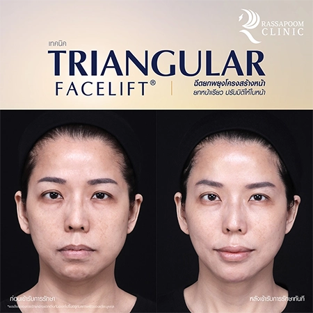 Triangular Face Lift คุณนก วาสนา