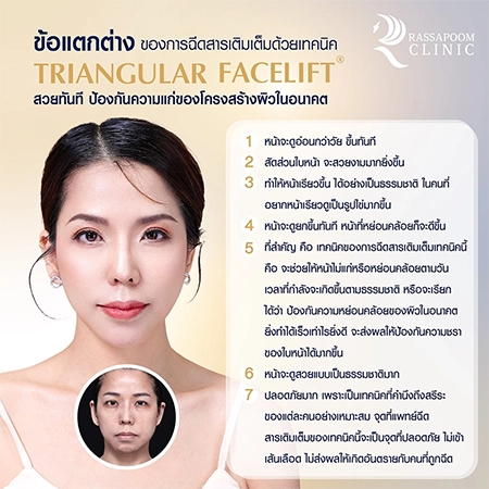 Triangular Face Lift คุณนก วาสนา