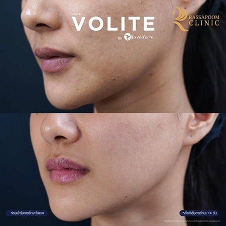 Juvederm Volite (คุณนิ)