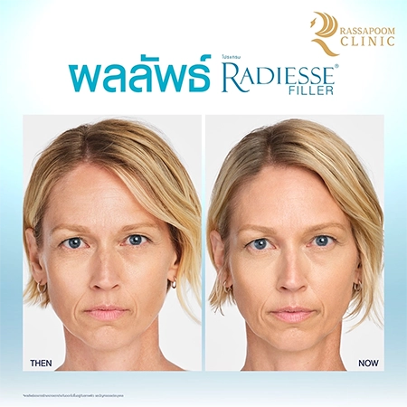 Radiesse Filler