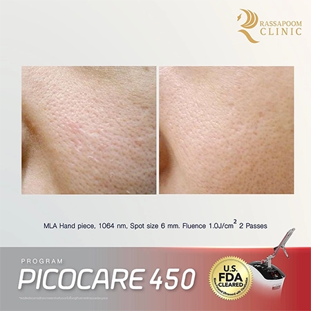 Picocare 450 Laser