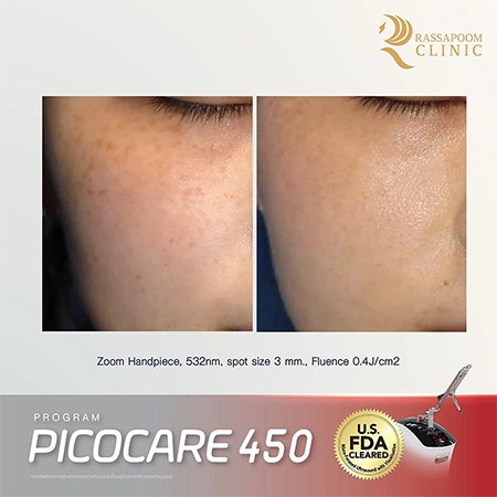 Picocare 450 Laser