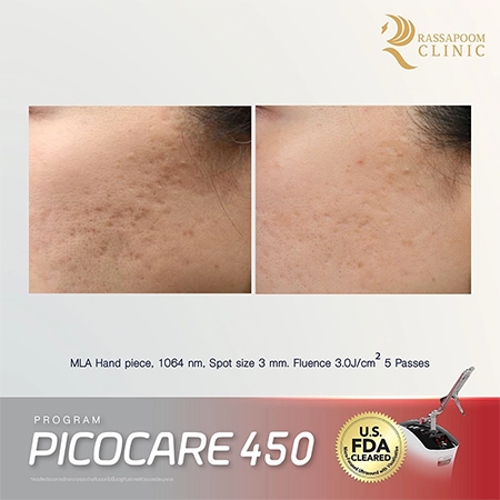 Picocare 450 Laser