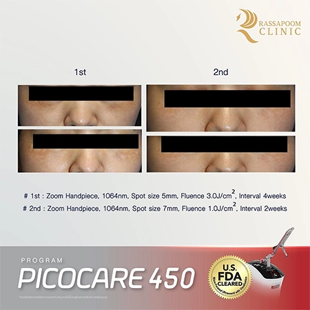 Picocare 450 Laser