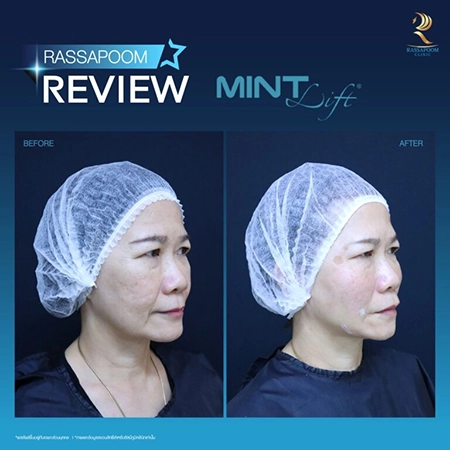 ร้อยไหมมิ้นท์ Mint Lift (คุณพัชร์)