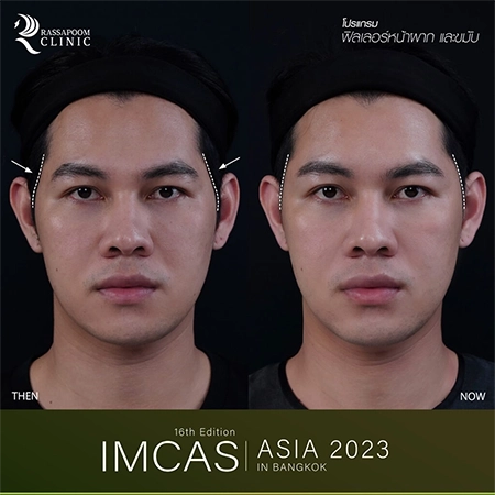 IMCAS ASIA 2023