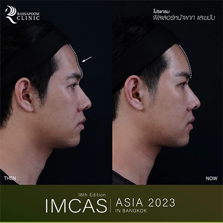 IMCAS ASIA 2023