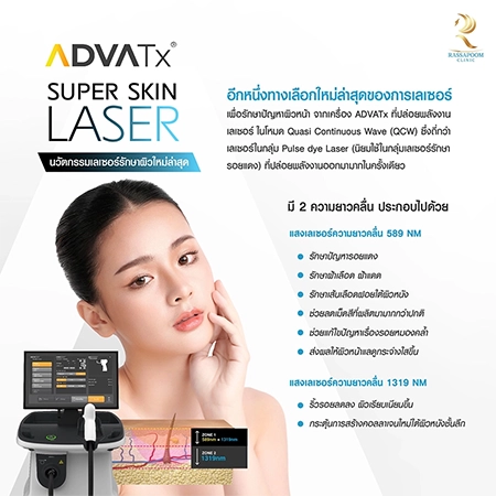 Super Skin Laser รักษาฝ้า กระ และจุดด่างดำ