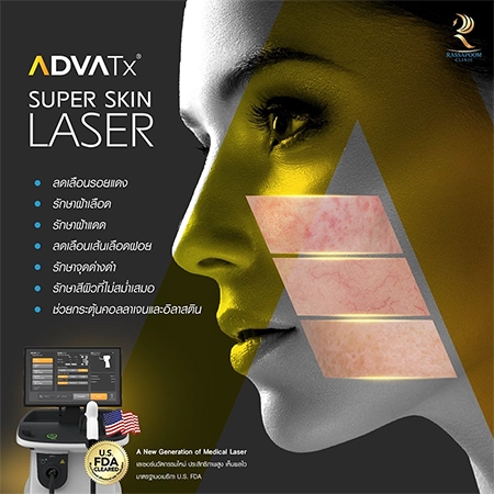 Super Skin Laser รักษาฝ้า กระ และจุดด่างดำ