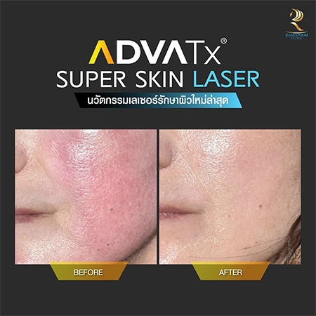 Super Skin Laser รักษาฝ้า กระ และจุดด่างดำ