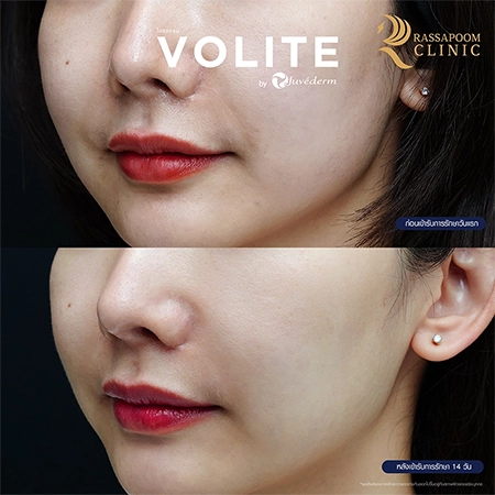 ฉีดฟิลเลอร์ (New Juvederm Volite)