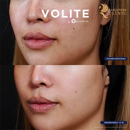 ฉีดฟิลเลอร์ (New Juvederm Volite)