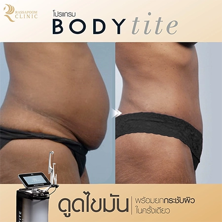 ดูดไขมัน BodyTite