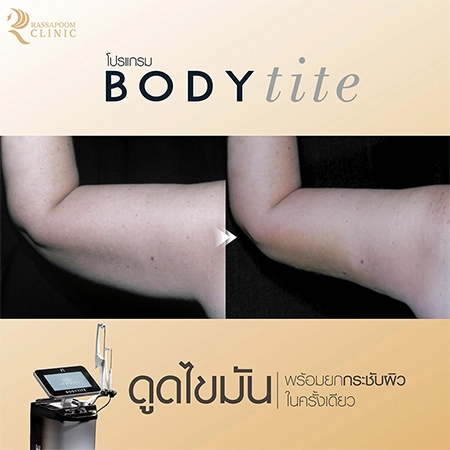 ดูดไขมัน BodyTite