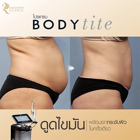 ดูดไขมัน BodyTite