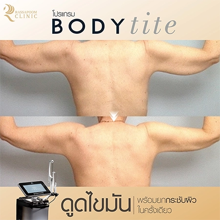 ดูดไขมัน BodyTite