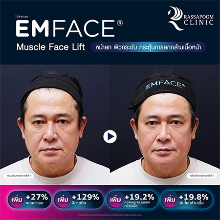 ยกกระชับกล้ามเนื้อ ยกกระชับ EMFACE