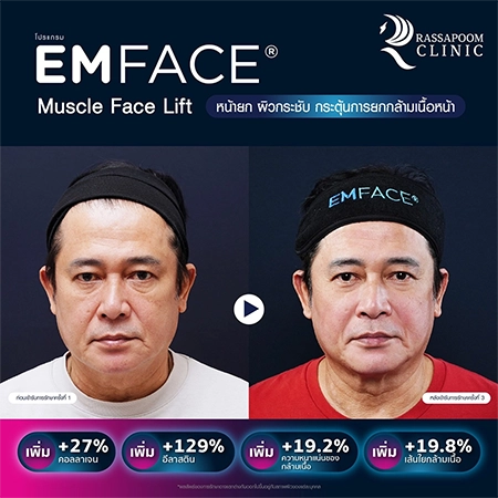 ยกกระชับกล้ามเนื้อ ยกกระชับ EMFACE