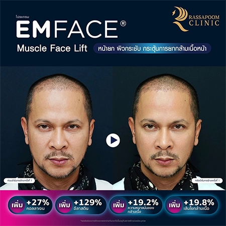 ยกกระชับกล้ามเนื้อ ยกกระชับ EMFACE