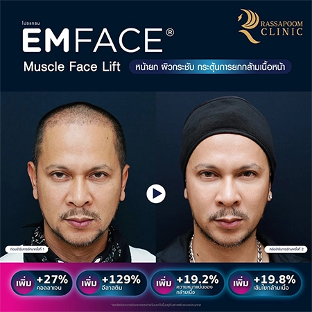 ยกกระชับกล้ามเนื้อ ยกกระชับ EMFACE