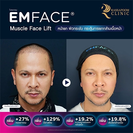 ยกกระชับกล้ามเนื้อ ยกกระชับ EMFACE